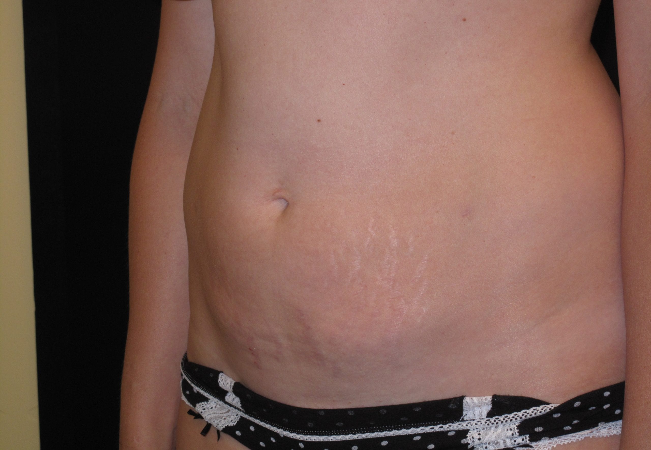 Liposuction Patient Photo - Case Case 2 - after view-0