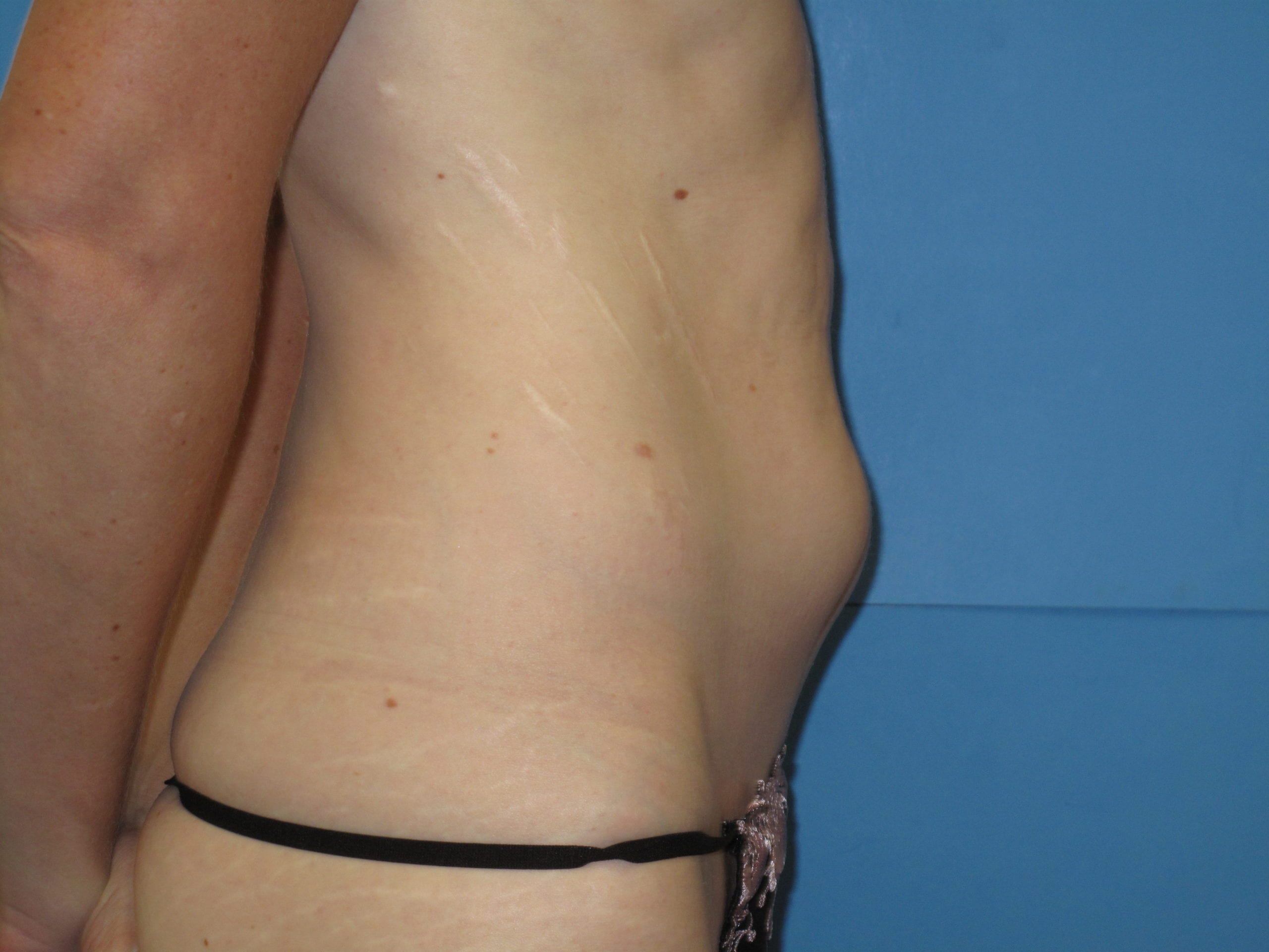 Liposuction Patient Photo - Case Case 3 - before view-1