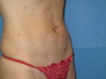 Liposuction - Case Case 3 - After