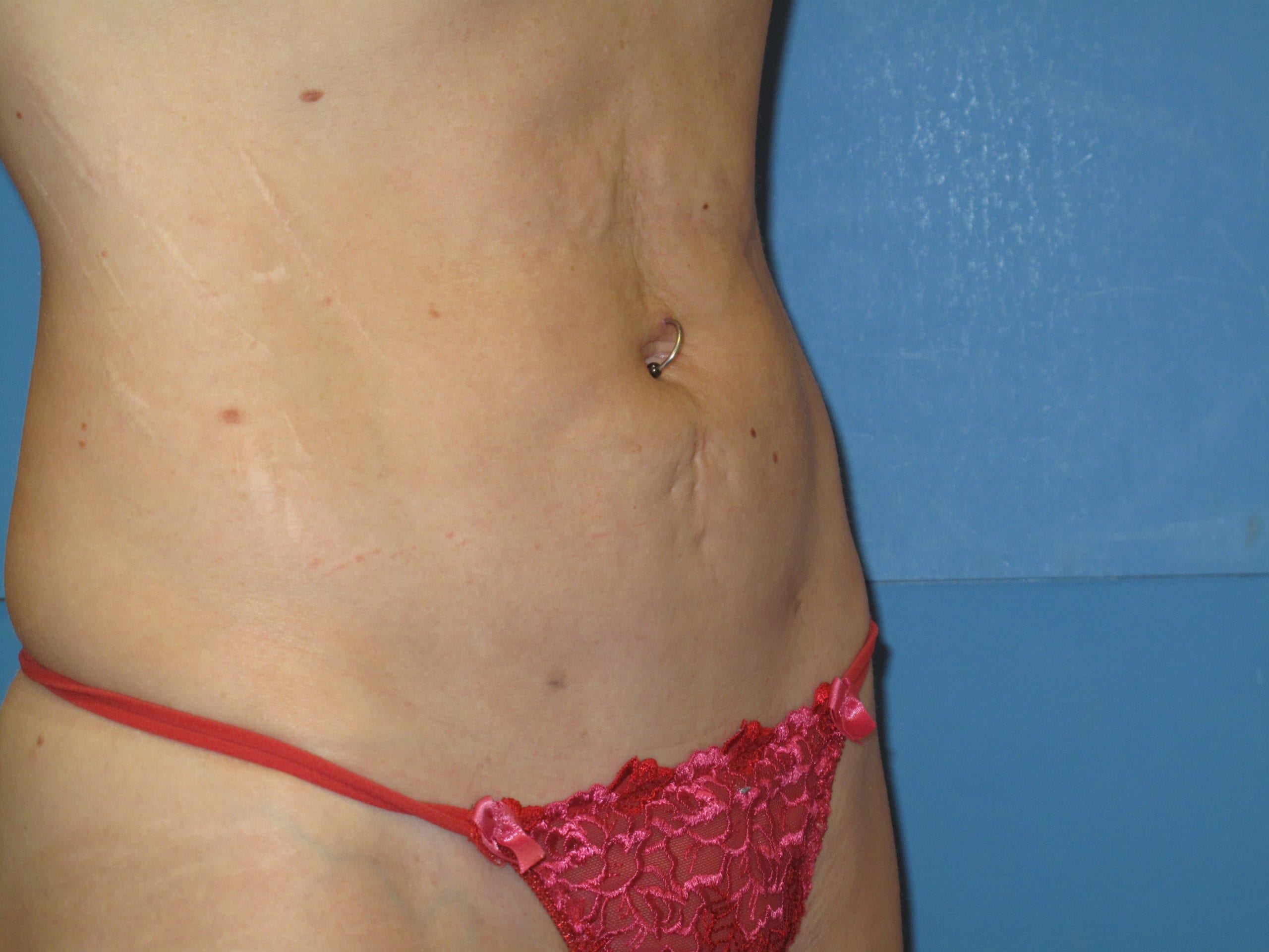 Liposuction Patient Photo - Case Case 3 - after view