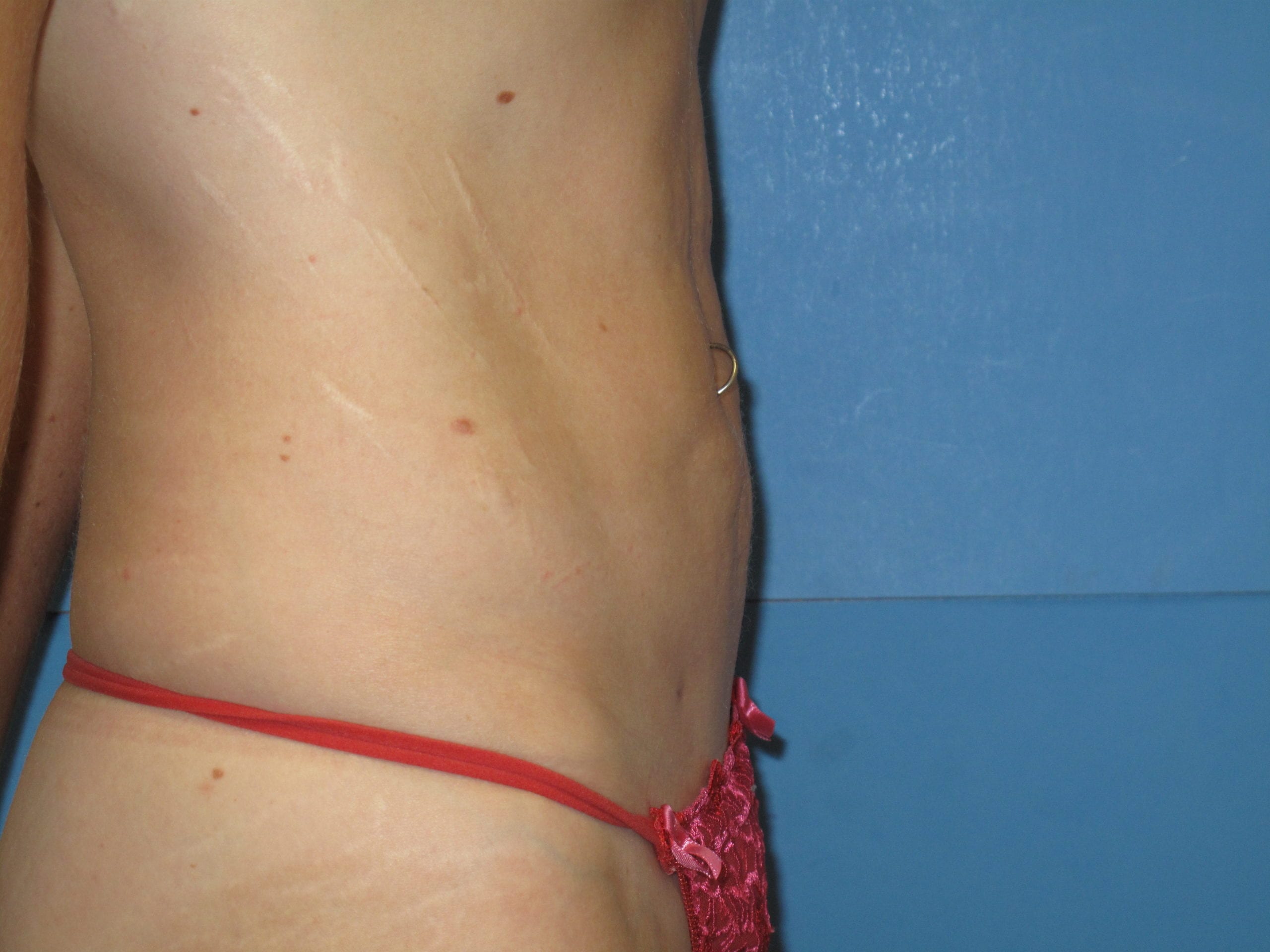 Liposuction Patient Photo - Case Case 3 - after view-1