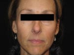 Nose Surgery - Case Case 2 - After