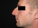 Nose Surgery - Case Case 3 - Before