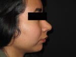 Nose Surgery - Case Case 4 - Before
