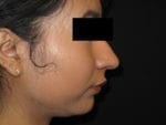 Nose Surgery - Case Case 4 - After