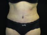 Tummy Tuck - Case Case 17 - After