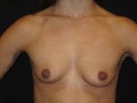 Breast Augmentation - Case Case 55 - Before