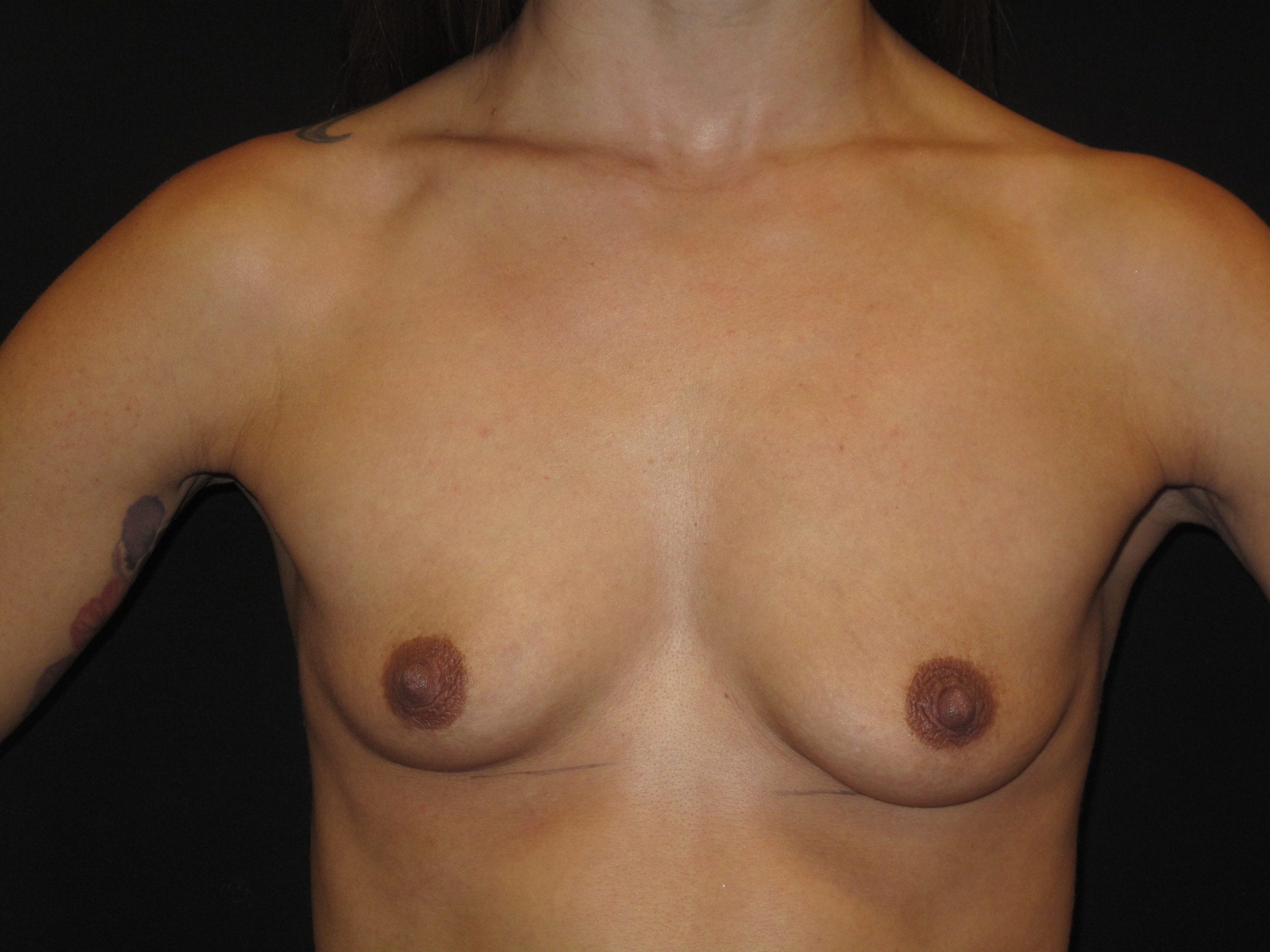 Breast Augmentation Patient Photo - Case Case 55 - before view-0