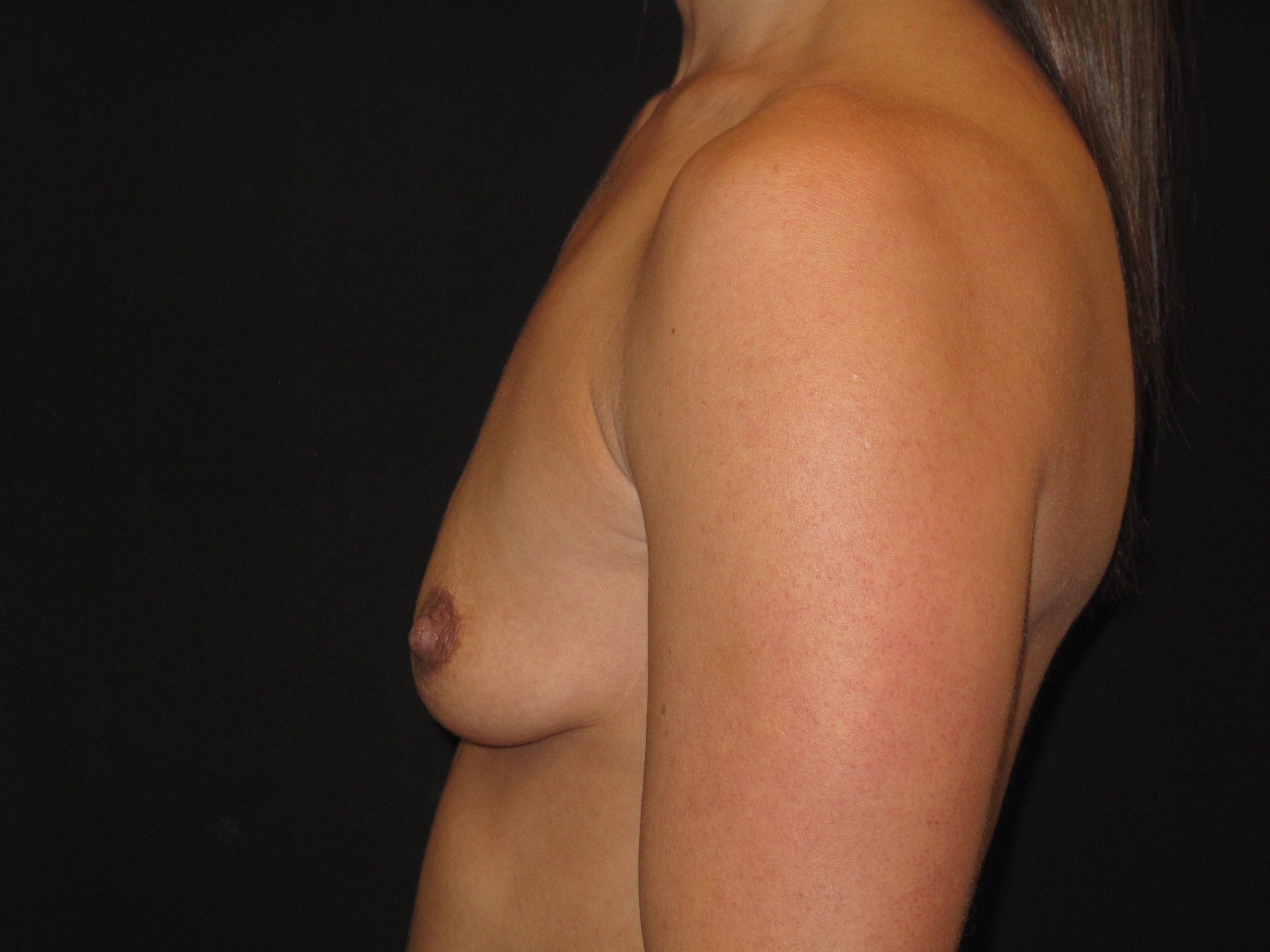Breast Augmentation Patient Photo - Case Case 55 - before view-1