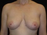 Breast Lift without Implants - Case Case 2 - Before