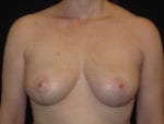 Breast Lift without Implants - Case Case 2 - After