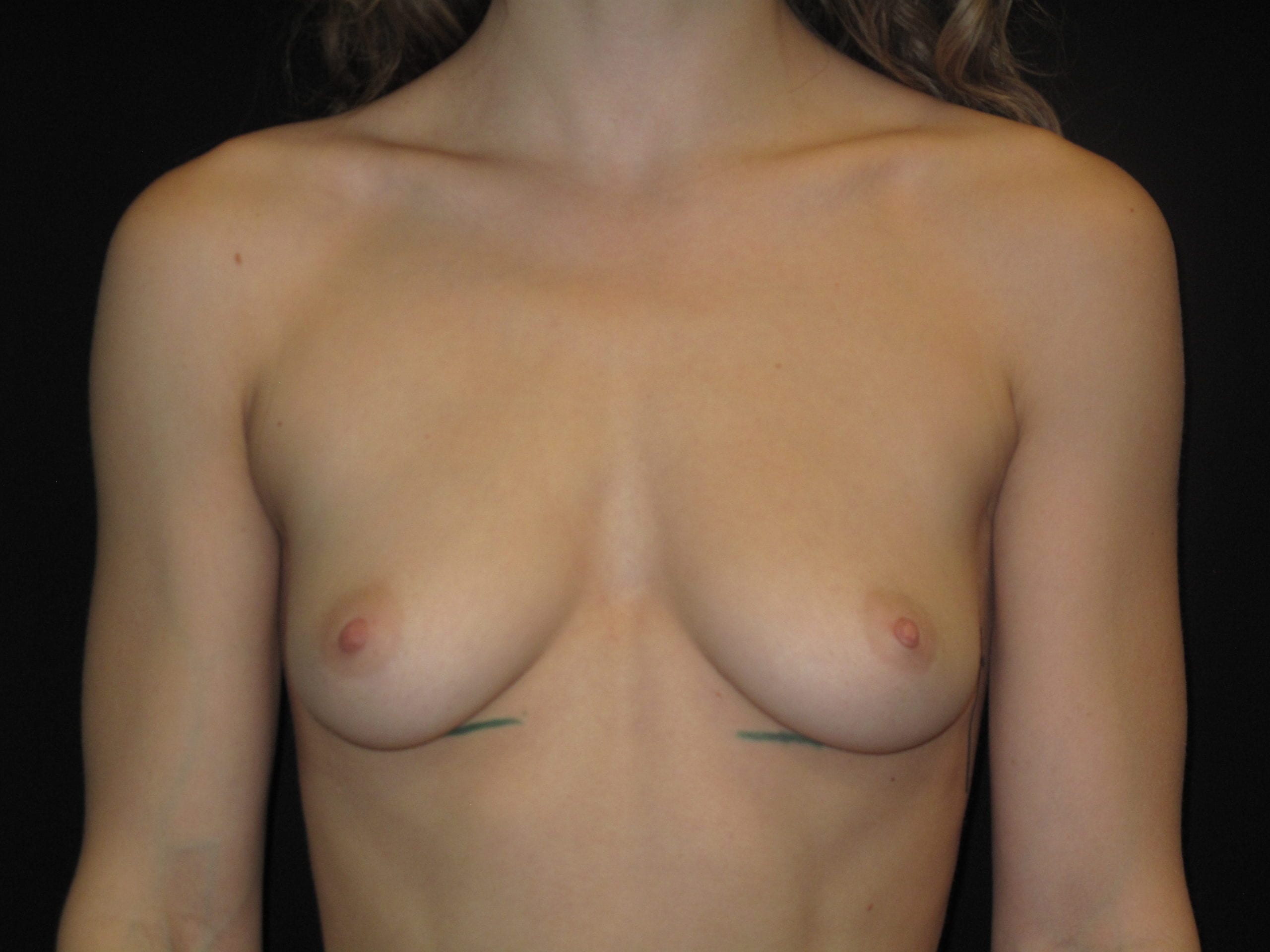 Breast Augmentation Patient Photo - Case Case 56 - before view-