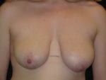 Breast Lift without Implants - Case Case 5 - Before