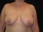 Breast Lift without Implants - Case Case 6 - Before