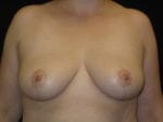 Breast Lift without Implants - Case Case 6 - After