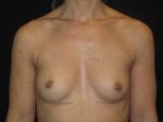 Breast Augmentation - Case Case 57 - Before