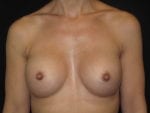 Breast Augmentation - Case Case 57 - After