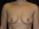 Breast Augmentation - Case Case 58 - Before