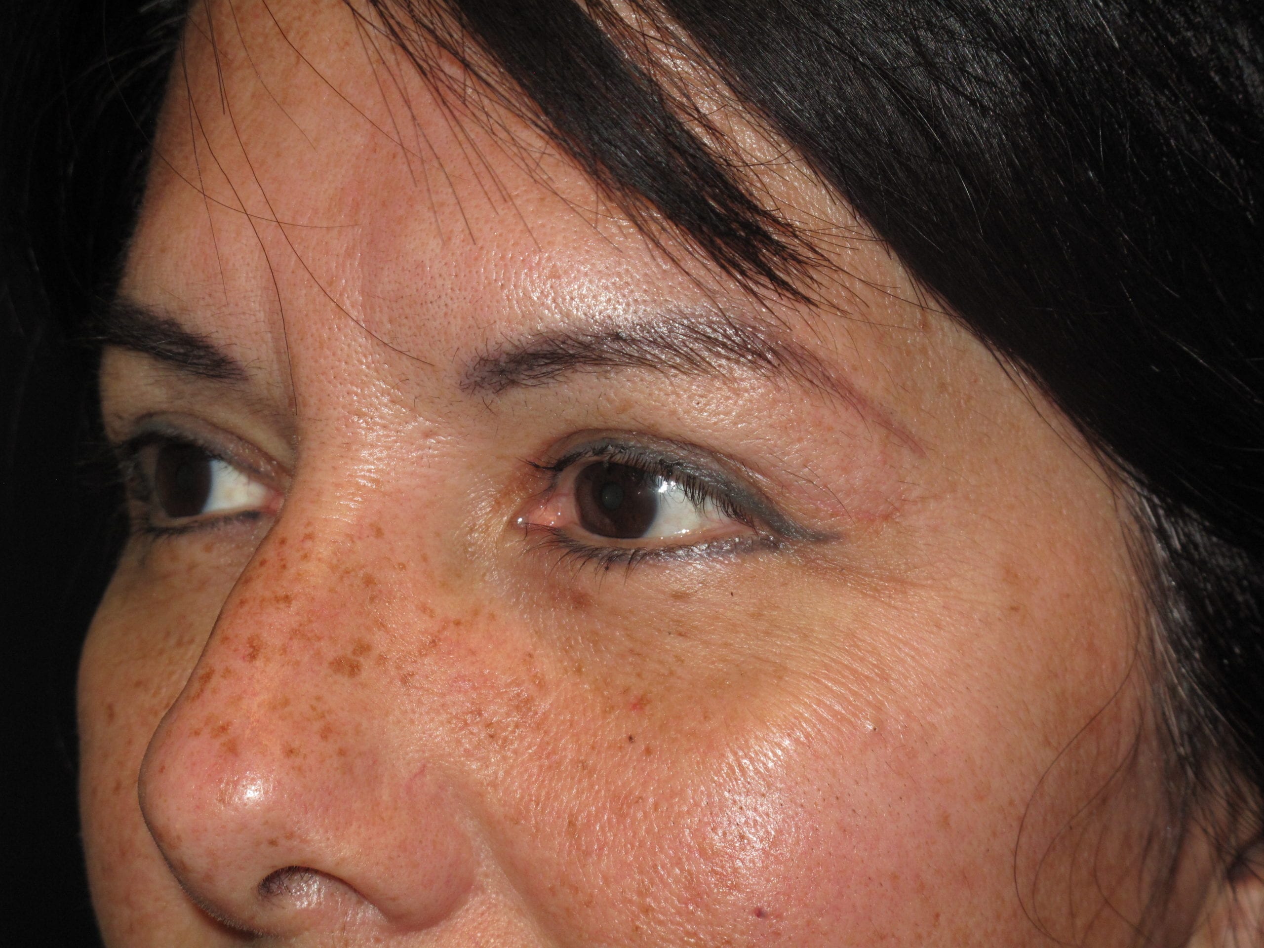 Eyelid Surgery Patient Photo - Case Case 4 - after view-1