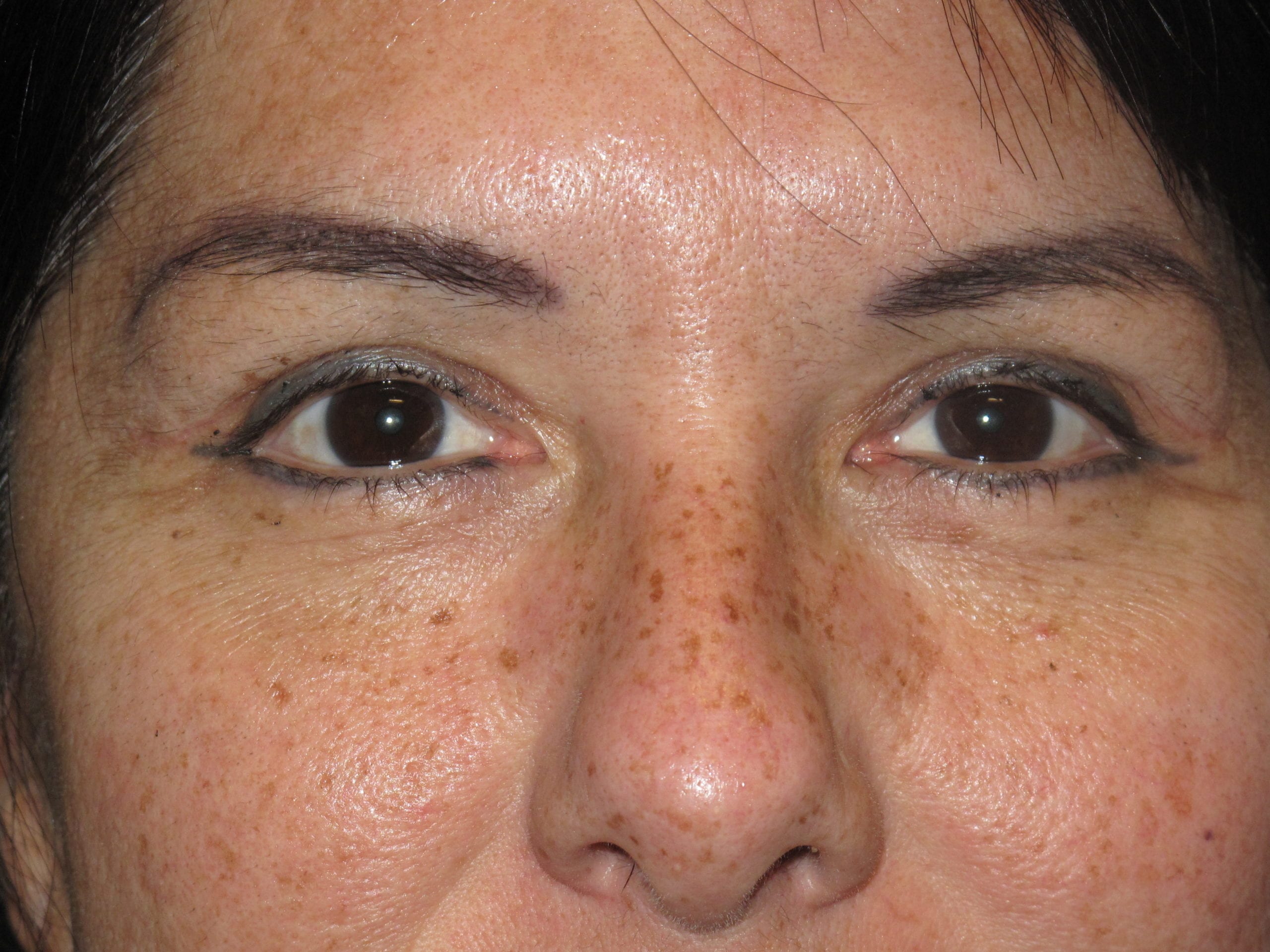 Eyelid Surgery Patient Photo - Case Case 4 - after view-0