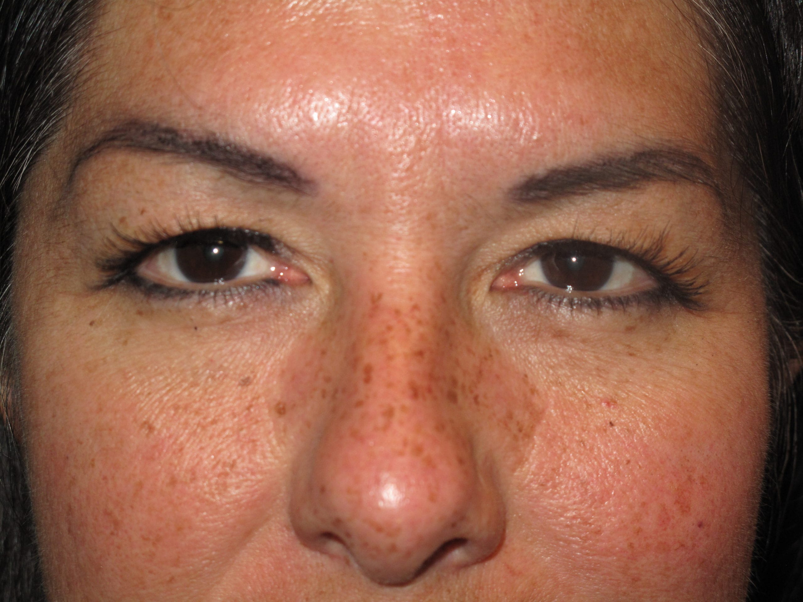 Eyelid Surgery Patient Photo - Case Case 4 - before view-0