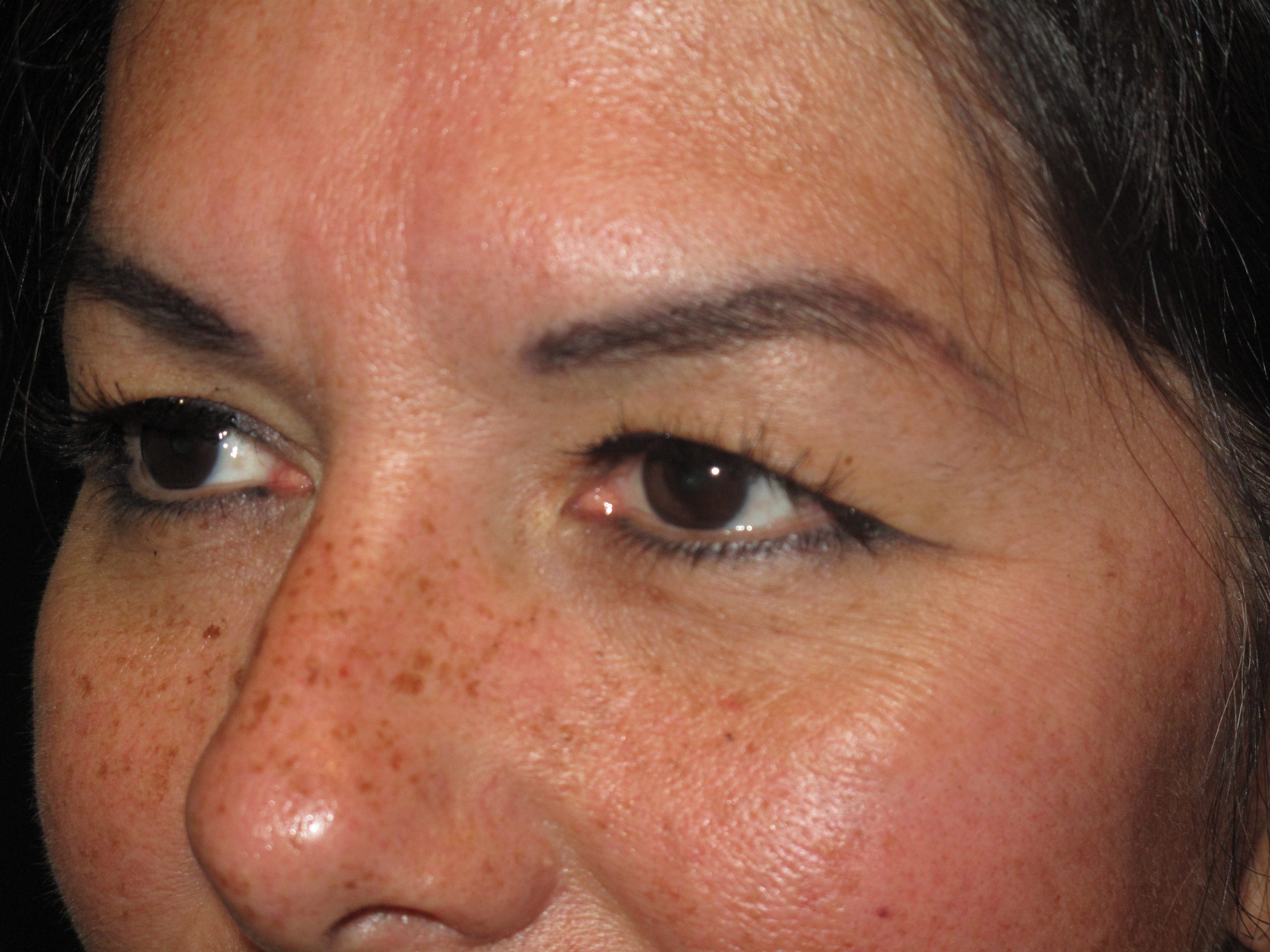 Eyelid Surgery Patient Photo - Case Case 4 - before view-1