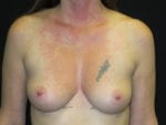 Breast Augmentation - Case Case 59 - Before
