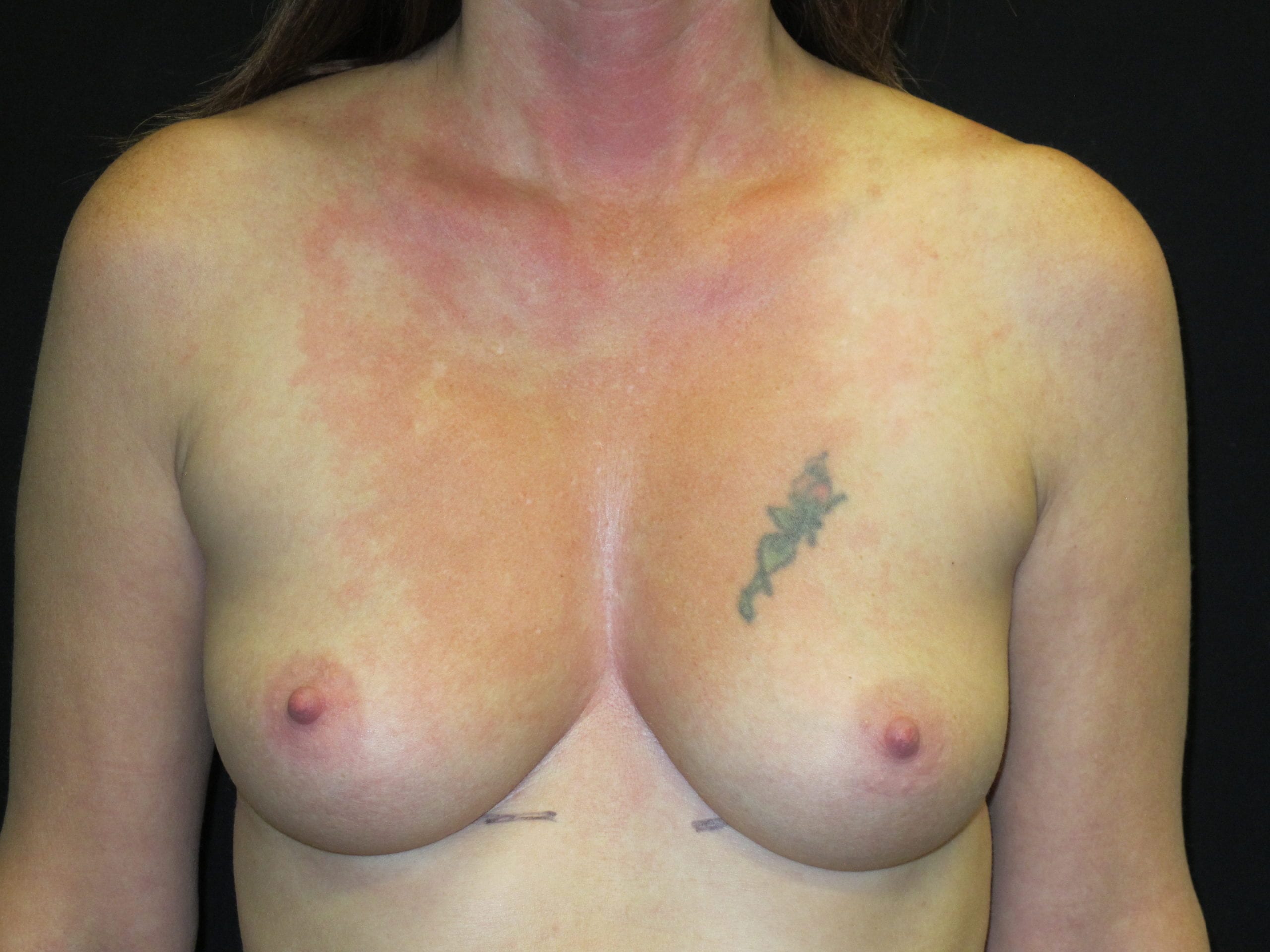 Breast Augmentation Patient Photo - Case Case 59 - before view-0