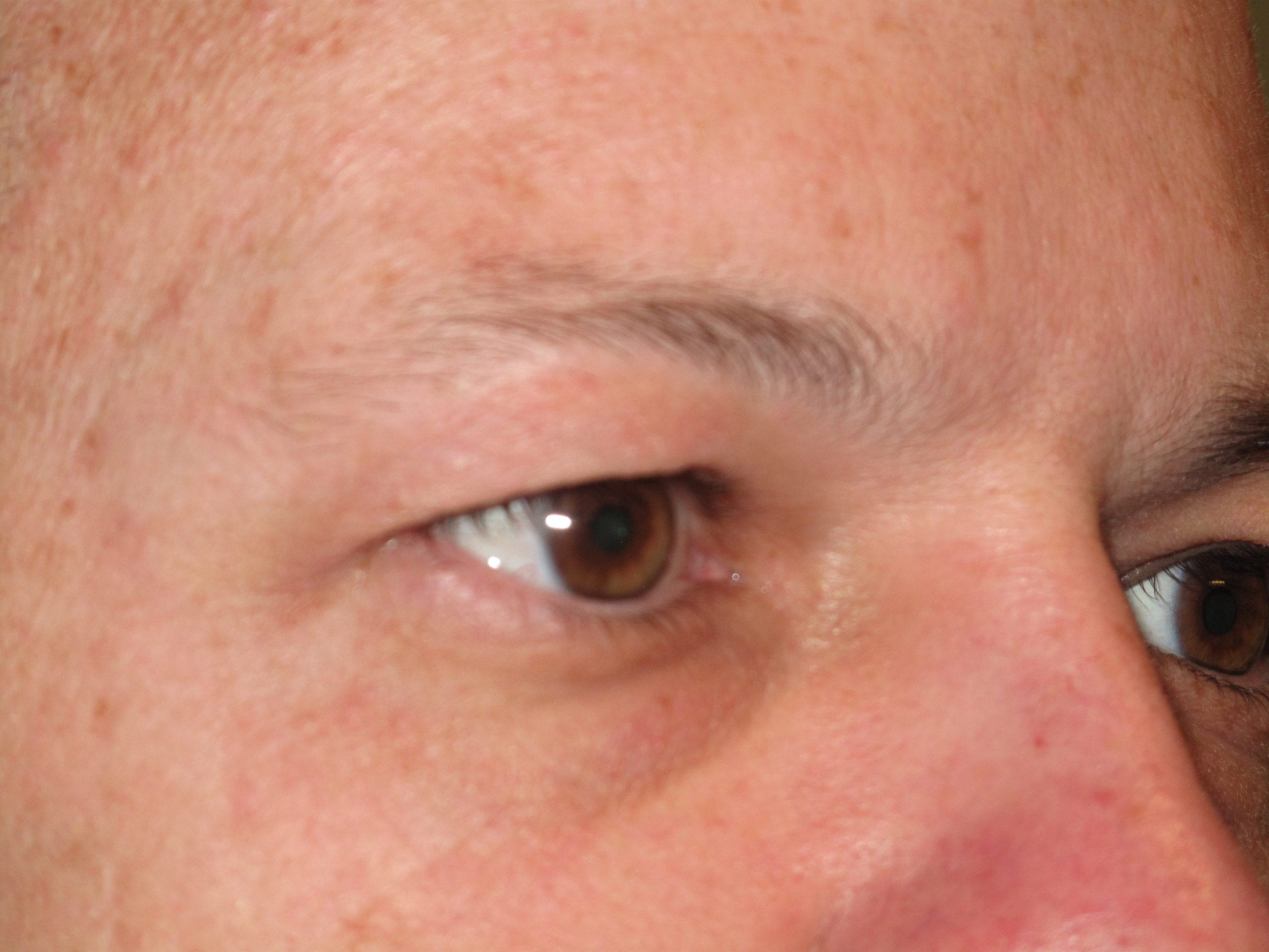 Eyelid Surgery Patient Photo - Case Case 5 - before view-1