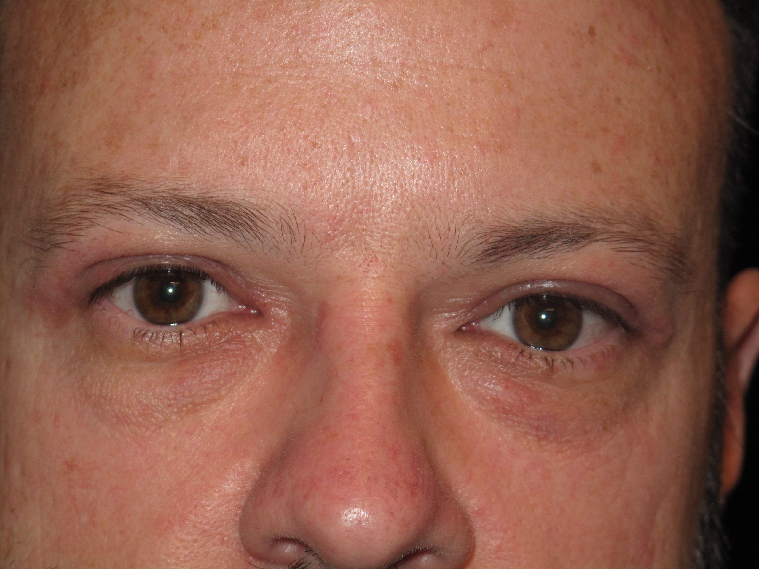 Eyelid Surgery Patient Photo - Case Case 5 - after view