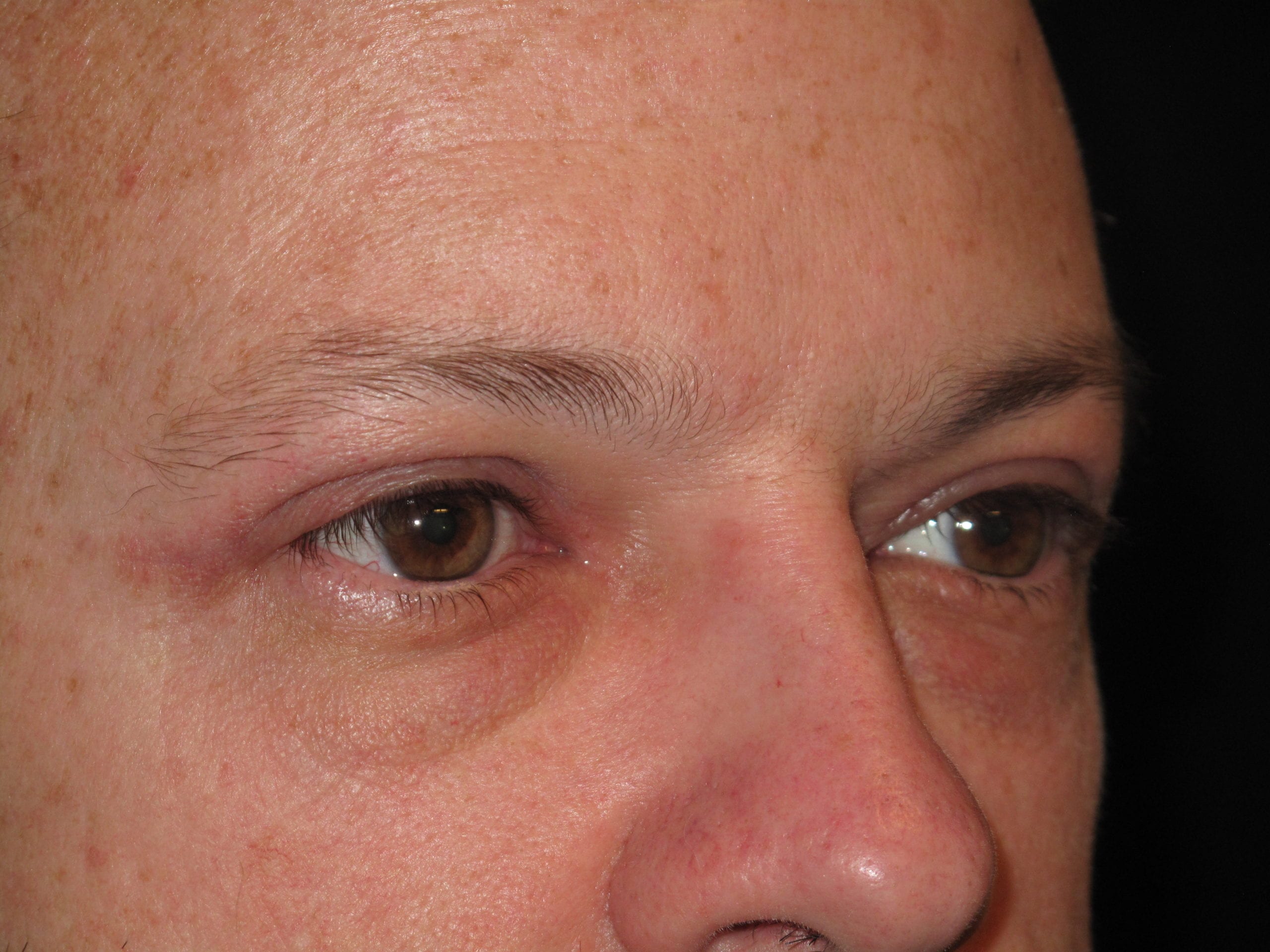 Eyelid Surgery Patient Photo - Case Case 5 - after view-1