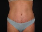 Tummy Tuck - Case Case 18 - After