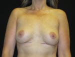 Breast Implant Revision - Case Case 5 - Before