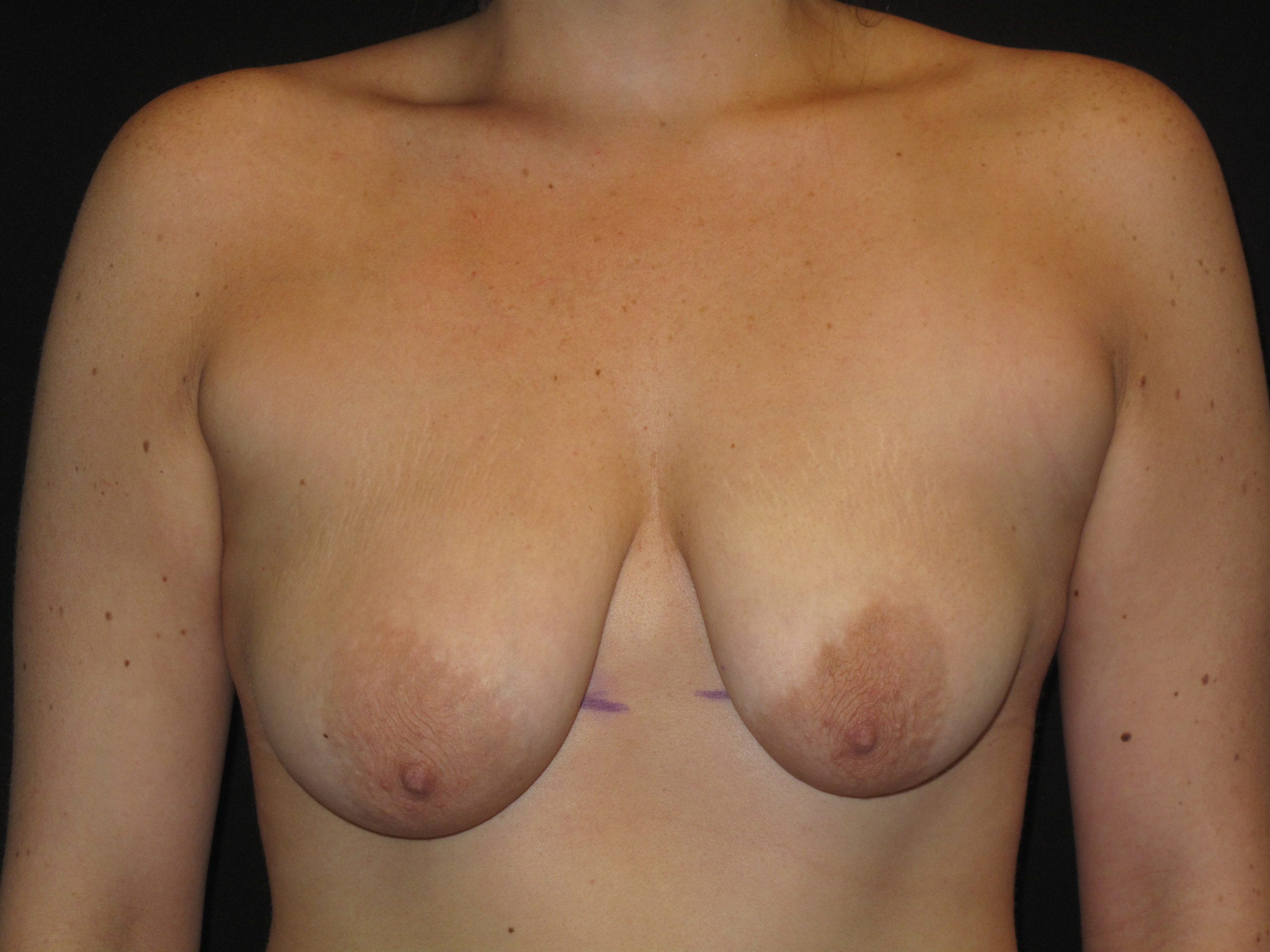 Breast Lift w/ Augmentation Patient Photo - Case Case 11 - before view-0