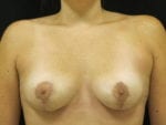 Breast Lift w/ Augmentation - Case Case 11 - After