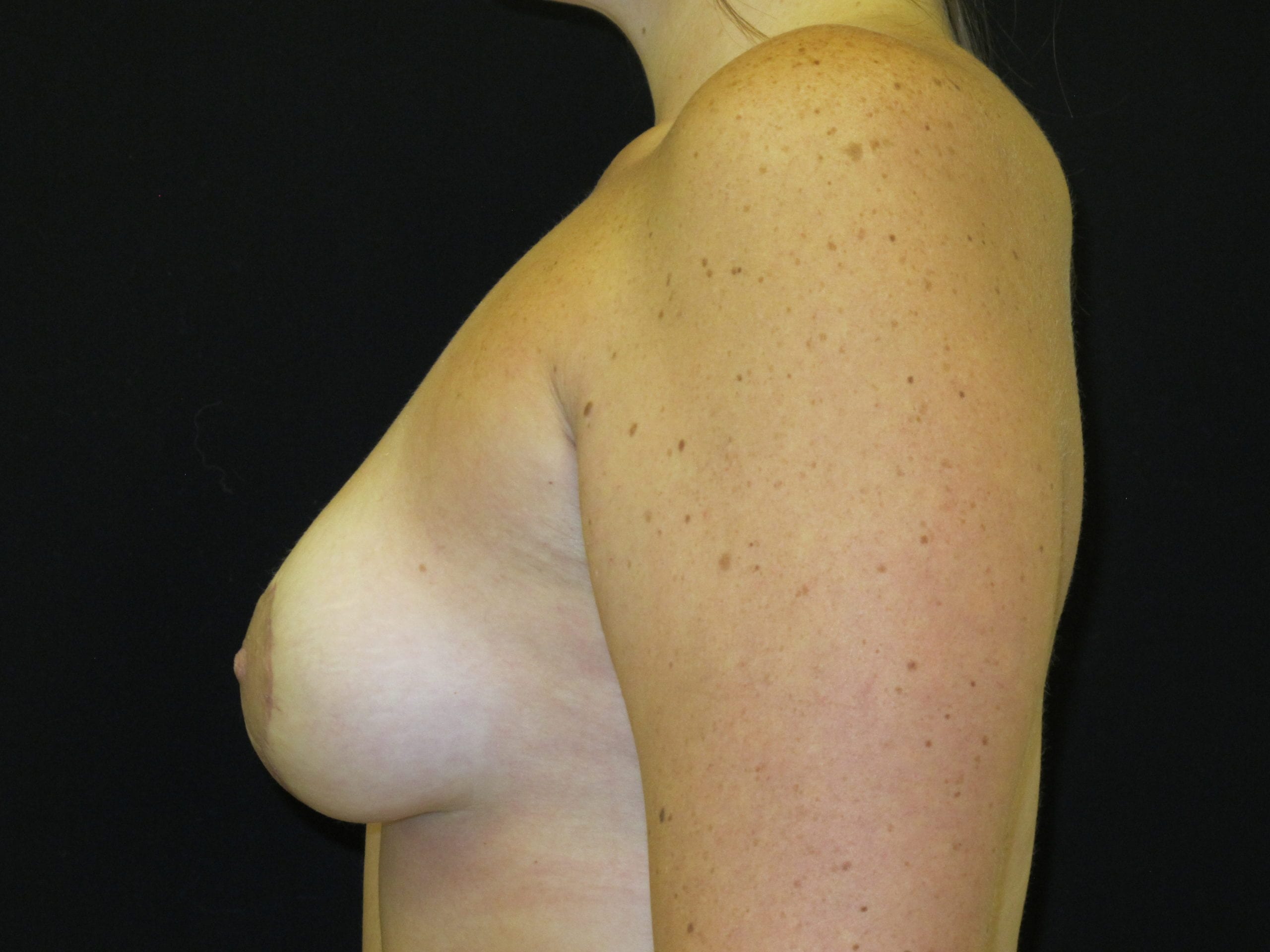 Breast Lift w/ Augmentation Patient Photo - Case Case 11 - after view-2