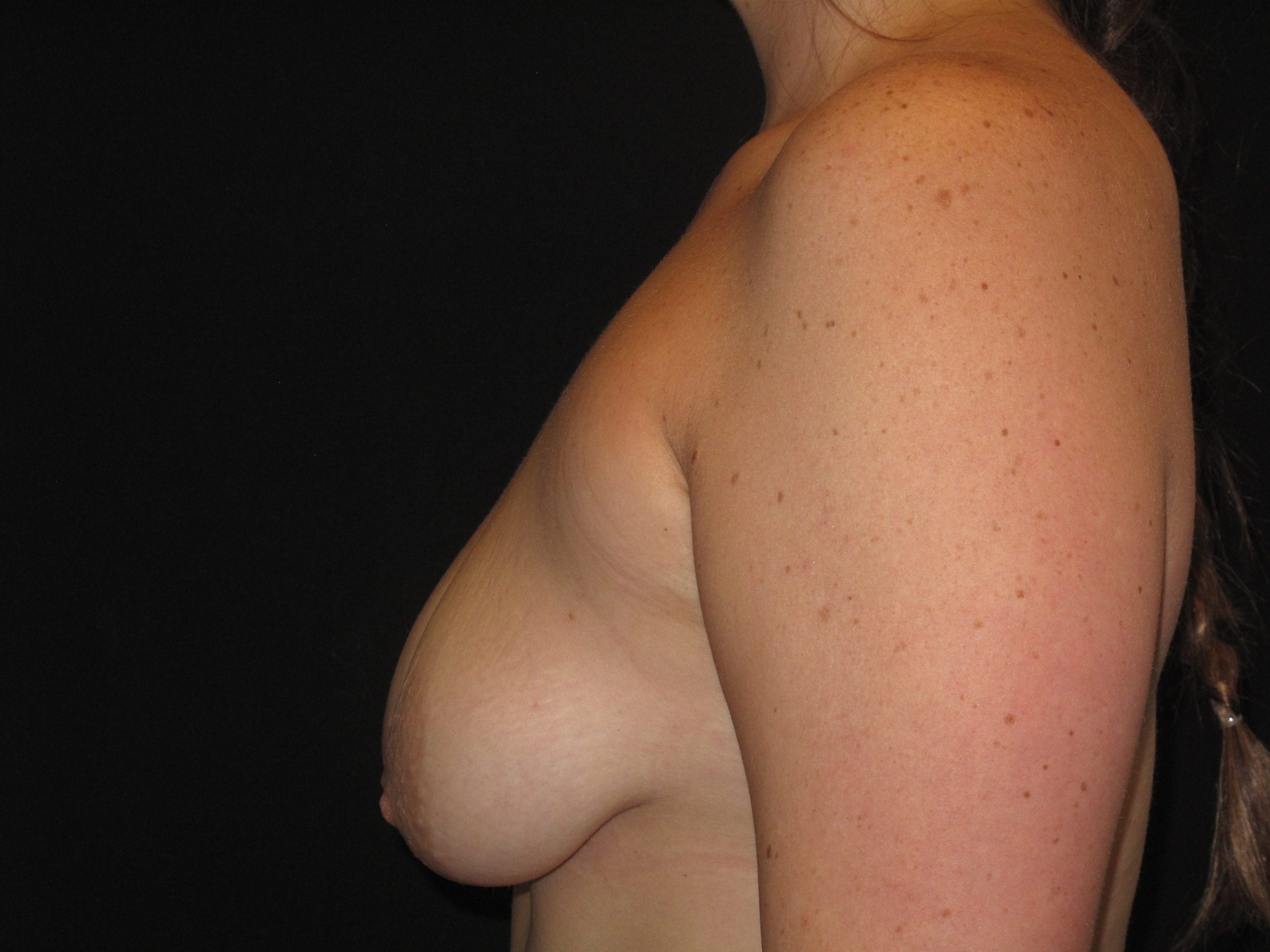Breast Lift w/ Augmentation Patient Photo - Case Case 11 - before view-2