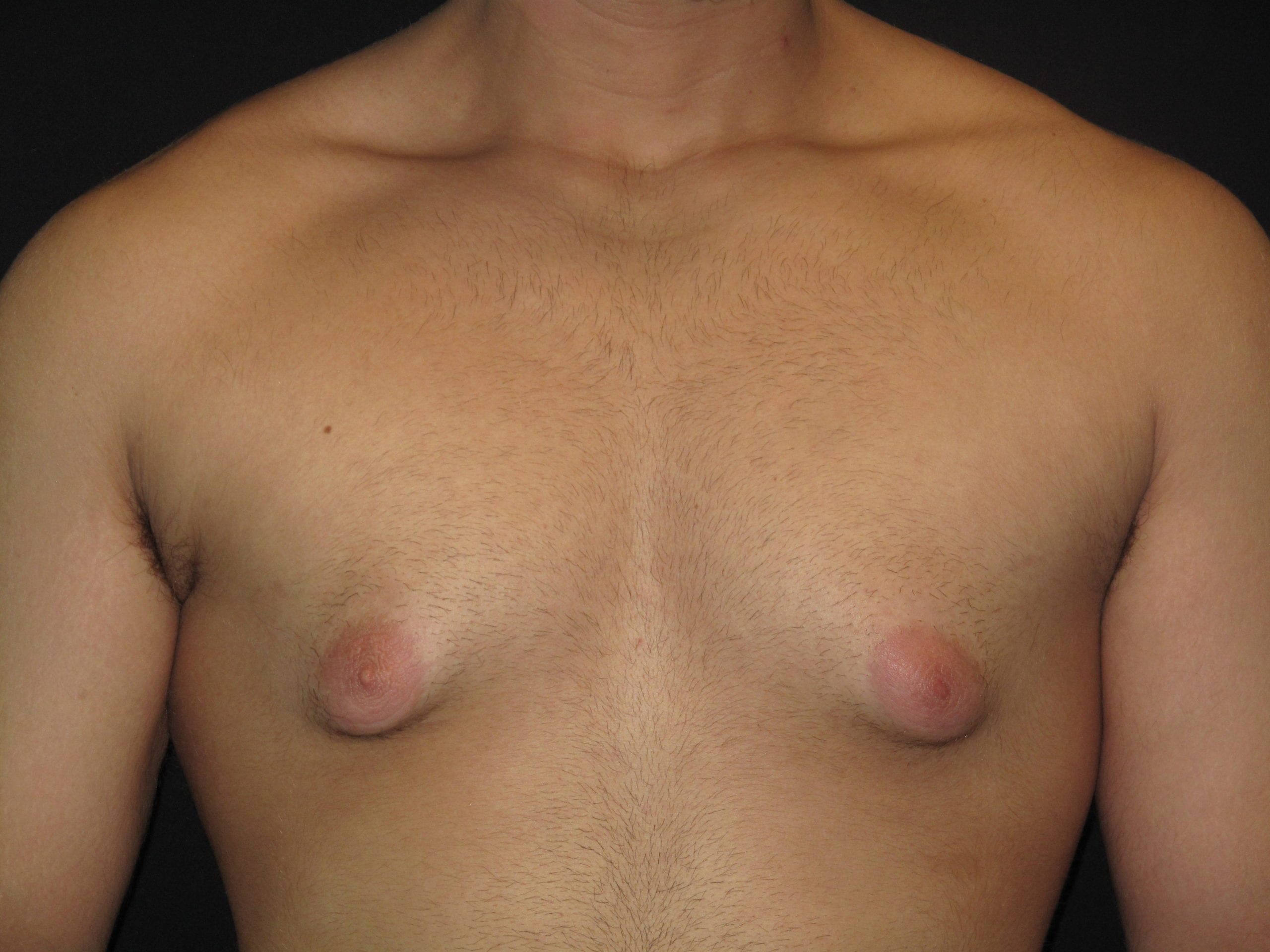 Male Breast Reduction Patient Photo - Case Case 4 - before view-