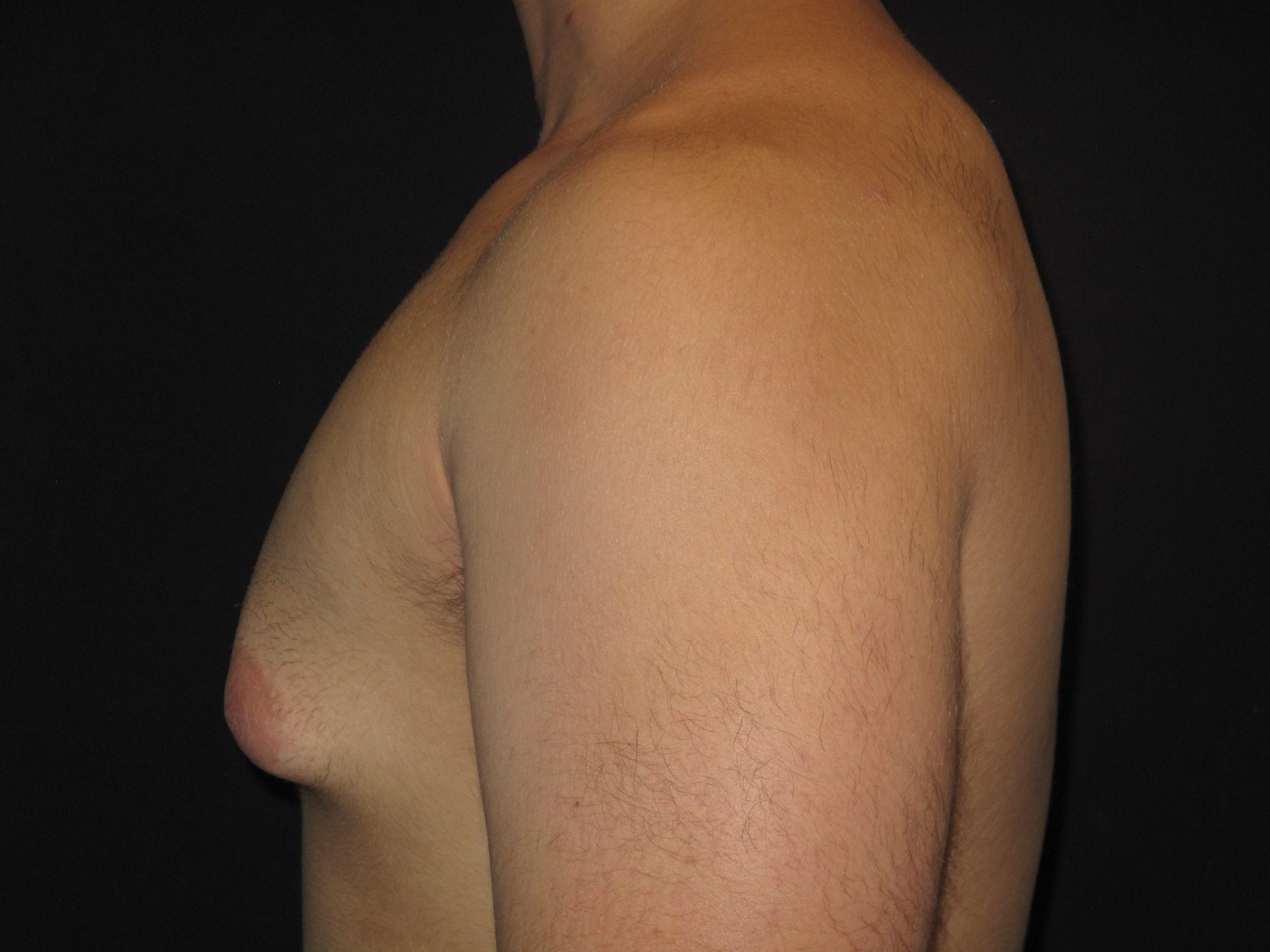 Male Breast Reduction Patient Photo - Case Case 4 - before view-2