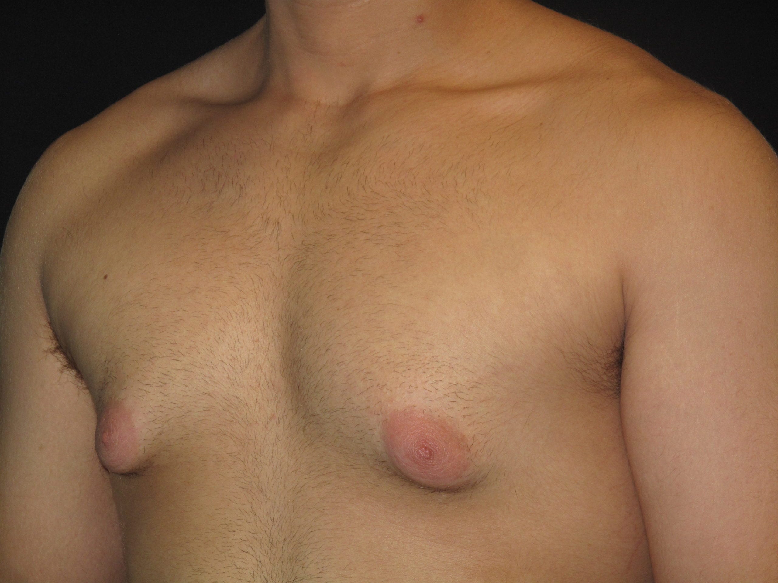 Male Breast Reduction Patient Photo - Case Case 4 - before view-1