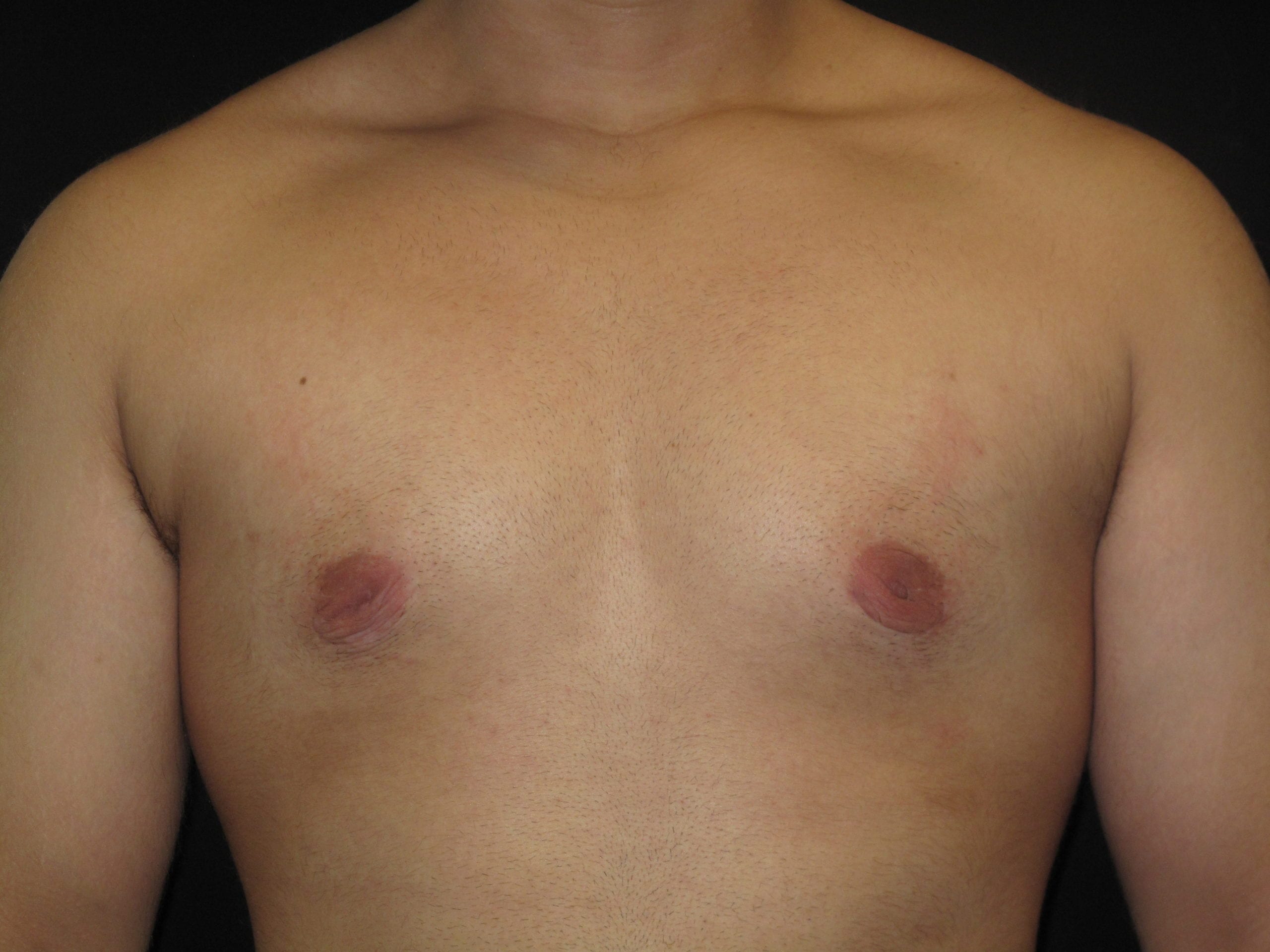 Male Breast Reduction Patient Photo - Case Case 4 - after view