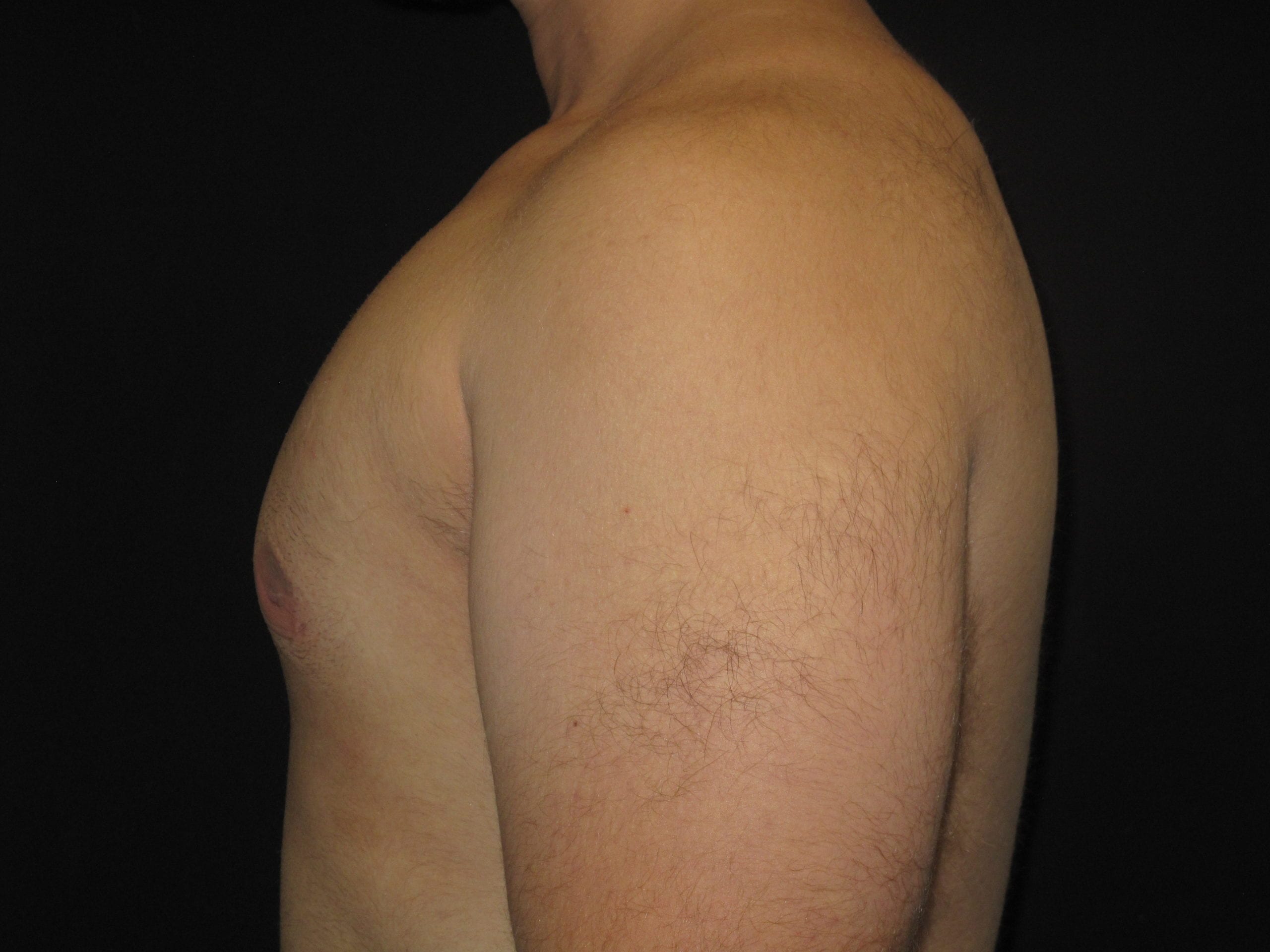 Male Breast Reduction Patient Photo - Case Case 4 - after view-2