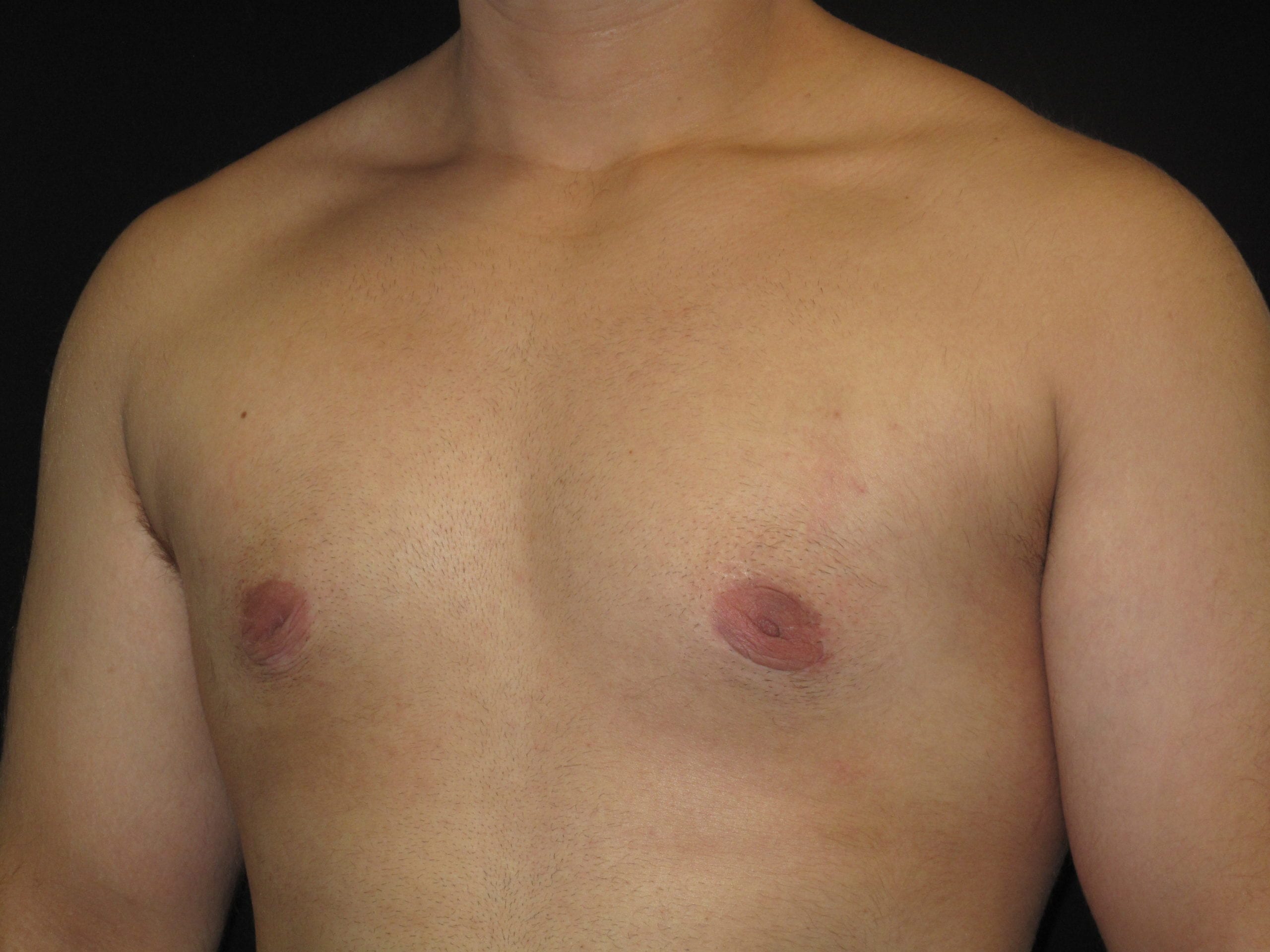Male Breast Reduction Patient Photo - Case Case 4 - after view-1