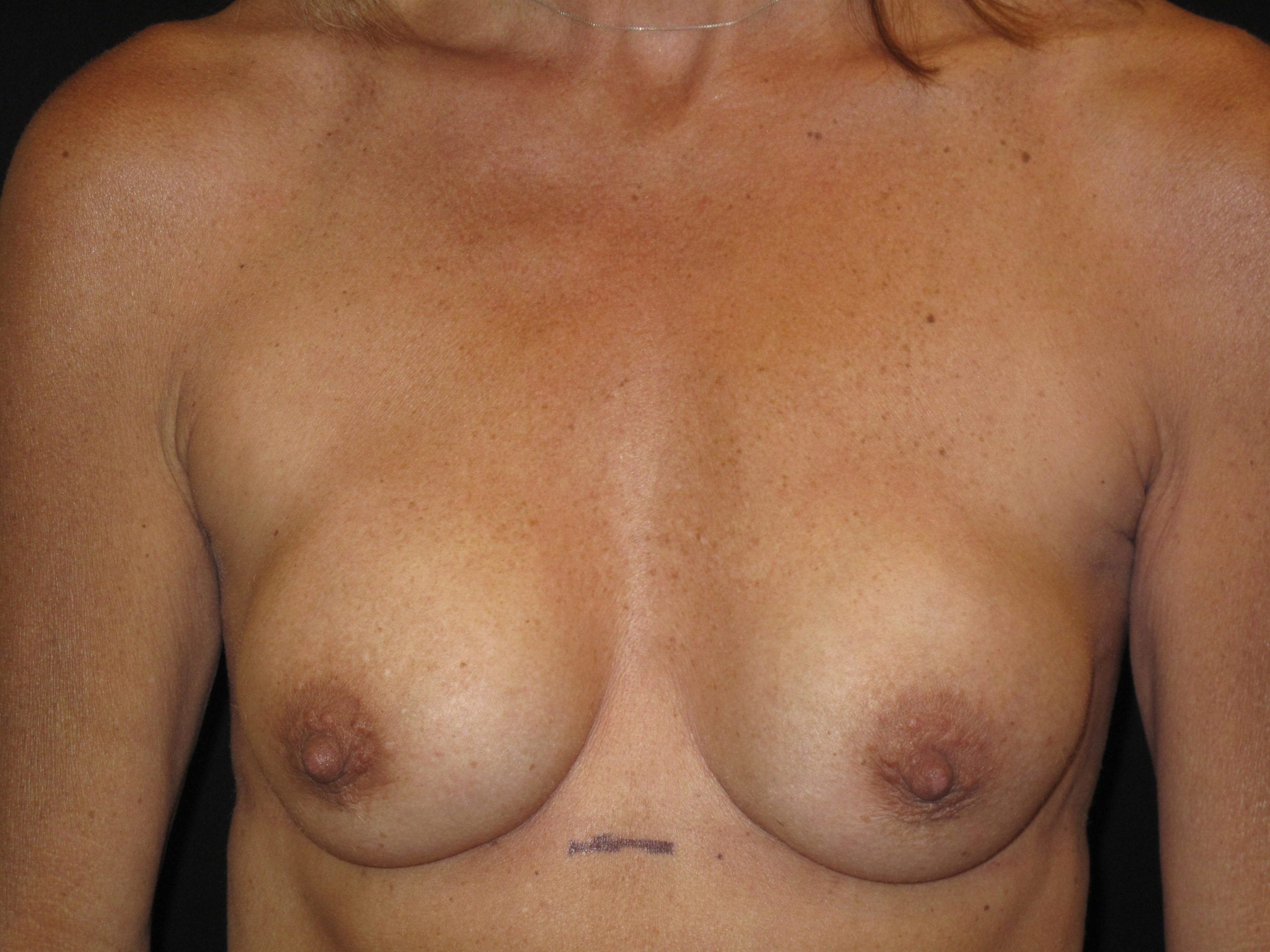 Breast Implant Revision Patient Photo - Case Case 6 - before view-