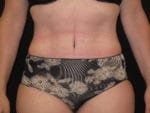 Tummy Tuck - Case Case 19 - After