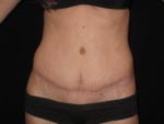 Tummy Tuck - Case Case 20 - After
