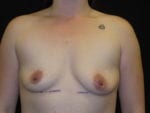 Breast Augmentation - Case Case 60 - Before