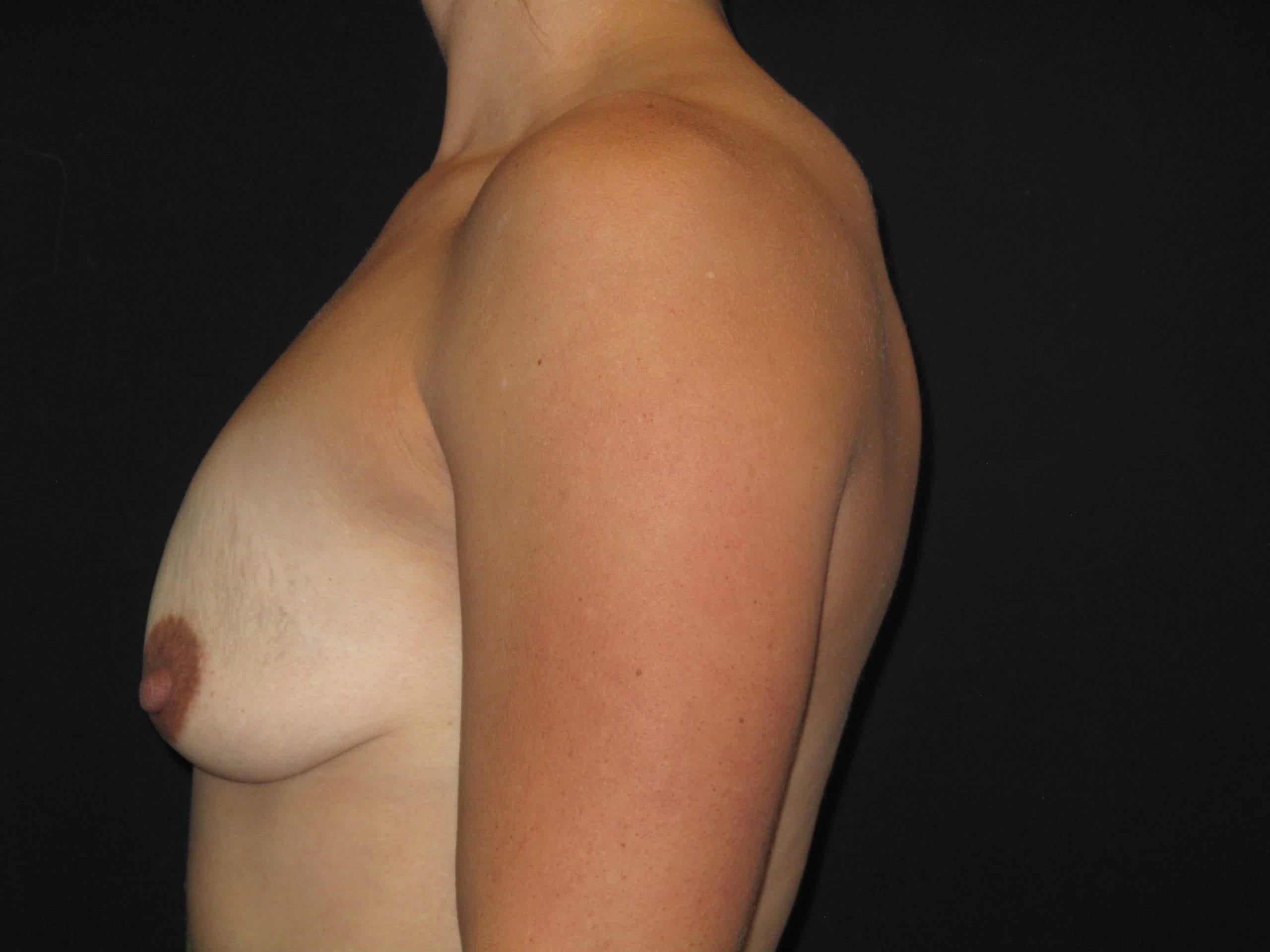 Breast Lift w/ Augmentation Patient Photo - Case Case 20 - before view-1