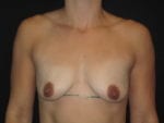 Breast Lift w/ Augmentation - Case Case 20 - Before