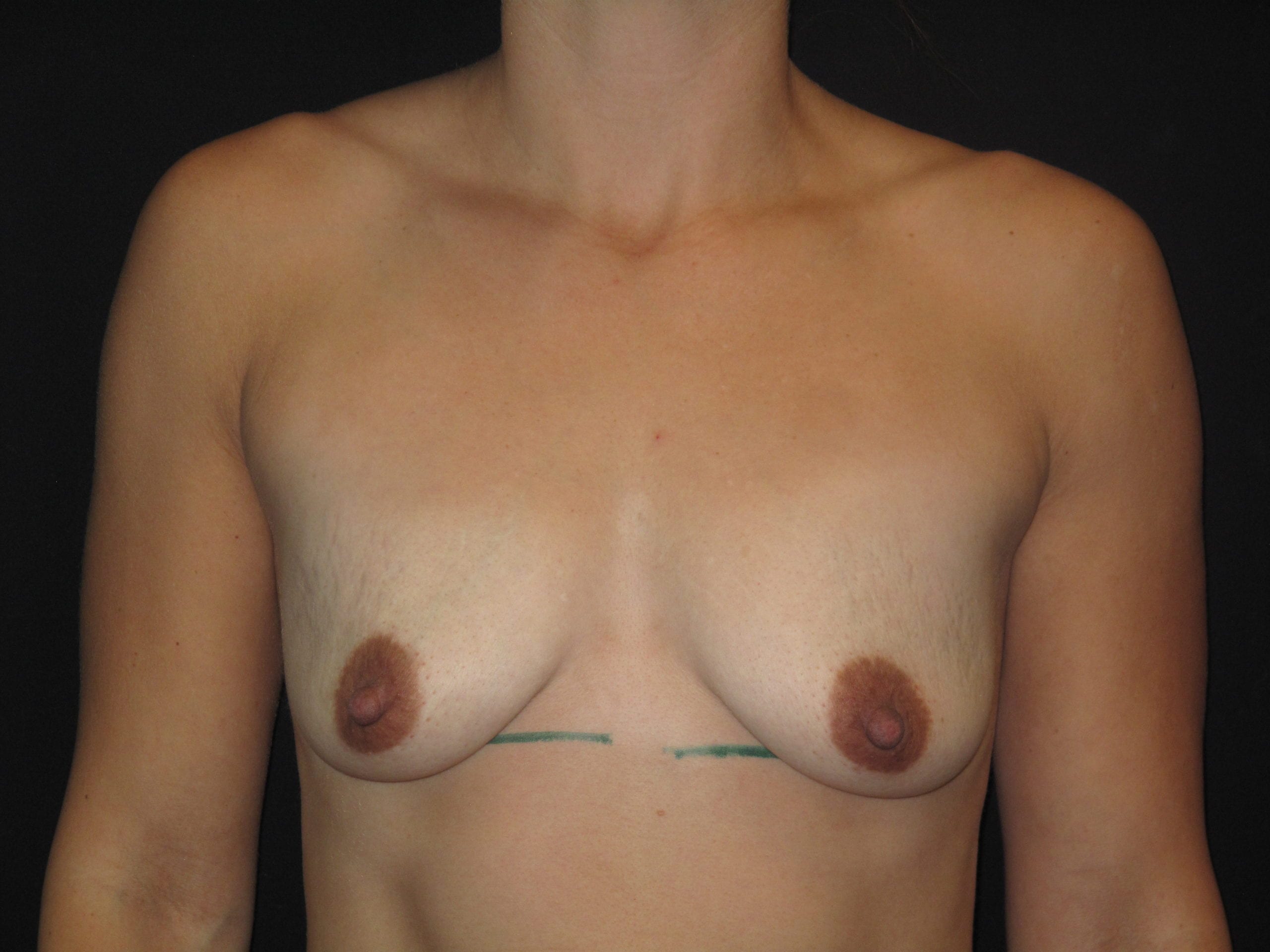 Breast Lift w/ Augmentation Patient Photo - Case Case 20 - before view-0